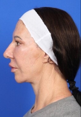 Case # 15 after photo