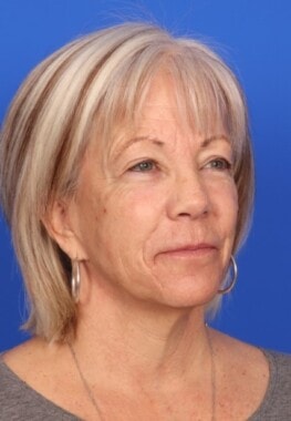 Case # 14 before photo