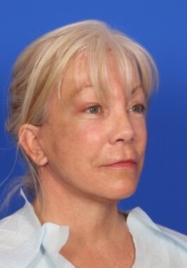 Case # 14 after photo