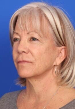 Case # 14 before photo