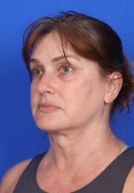 Case # 9 before photo