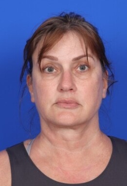 Case # 9 before photo