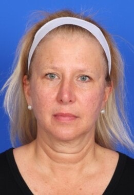 Case # 11 before photo