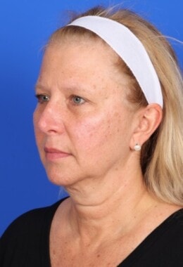 Case # 11 before photo