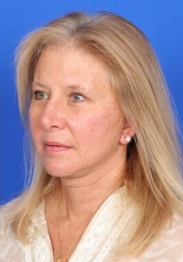 Case # 11 after photo