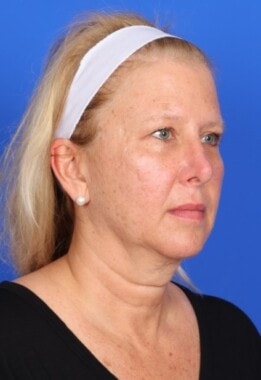 Case # 11 before photo