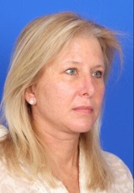 Case # 11 after photo