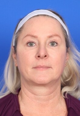 Case # 12 before photo