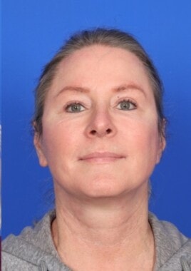 Case # 12 after photo