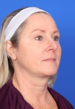 Case # 12 before photo