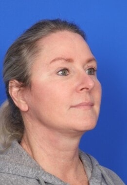 Case # 12 after photo