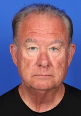 Case # 6 before photo