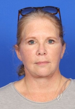 Case # 13 after photo