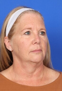 Case # 13 before photo