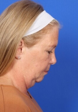 Case # 13 before photo