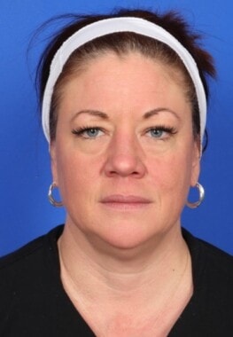 Case # 5 before photo