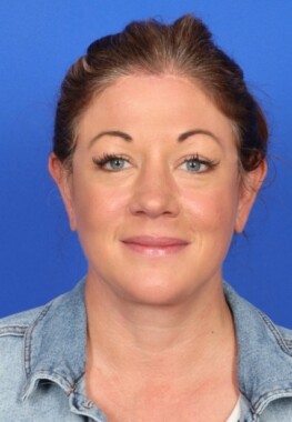 Case # 5 after photo