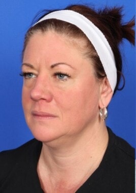 Case # 5 before photo