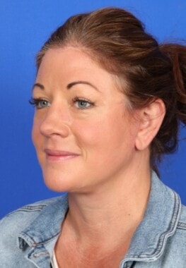 Case # 5 after photo