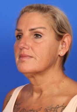 Case # 4 before photo