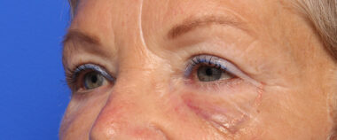 Case # 3 after photo