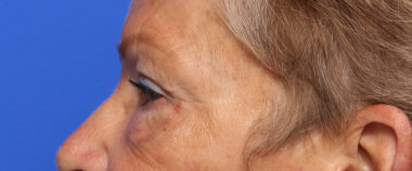 Case # 3 after photo