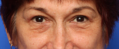 Case # 4 after photo