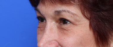 Case # 4 after photo