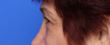 Case # 4 after photo