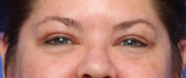 Case # 5 after photo