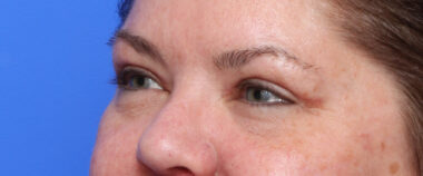 Case # 5 after photo