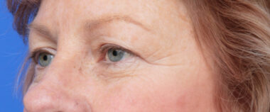 Case # 6 before photo