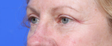 Case # 6 after photo