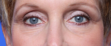 Case # 1 after photo