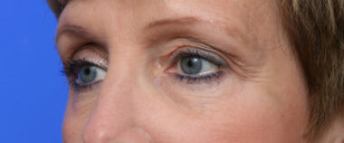 Case # 1 before photo