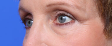 Case # 1 after photo