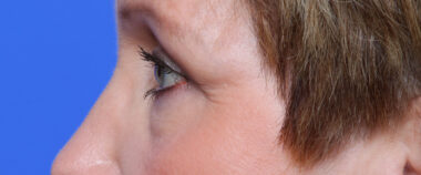 Case # 1 after photo