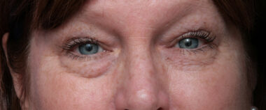 Case # 7 before photo