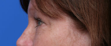 Case # 7 before photo