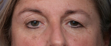 Case # 8 before photo