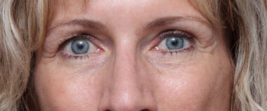 Case # 11 before photo