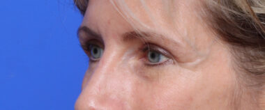 Case # 11 after photo