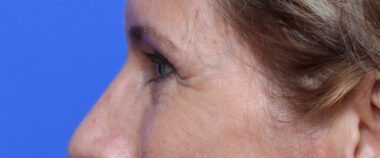 Case # 11 before photo