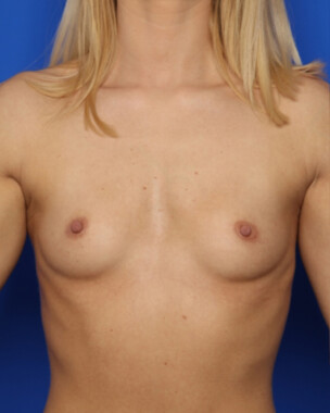 Case # 52 before photo