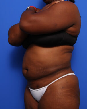 Case # 11 after photo