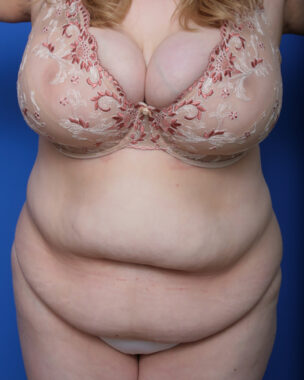 Case # 1 before photo