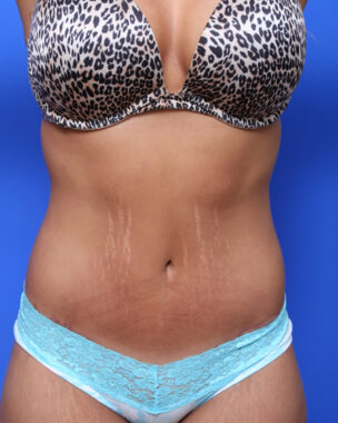 Case # 4 after photo