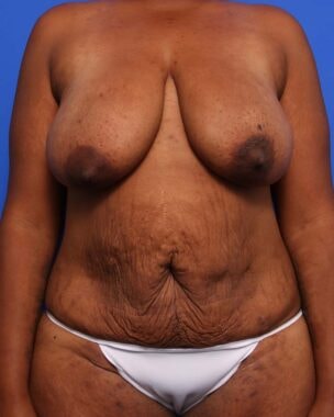 Case # 15 after photo