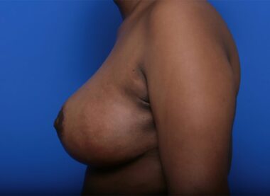 Case # 3 after photo