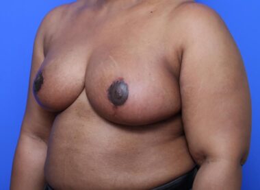 Case # 14 after photo